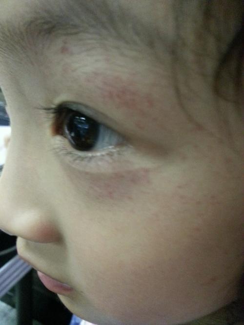 中途休息时发现眼角就变成了这样,估计太用力了,血点都蹦出来了,她