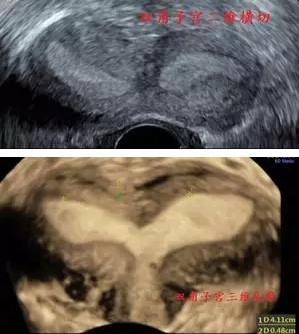 8种常见子宫畸形声像图!