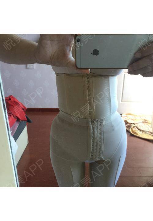 今天是腰腹环吸后的第16天了