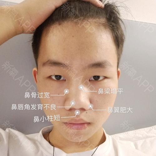 第一步:通过硅胶/膨体假体或肋软骨垫高鼻梁,解决