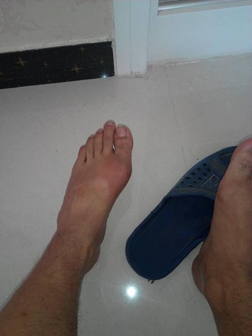 脚肿了好疼,这是什么病有人知道吗?