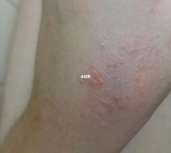 打疫苗后小红疹_红疹_疫苗_过敏_医疗健康_医疗健康