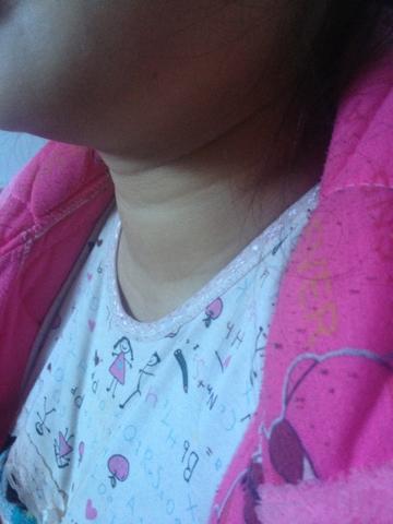 为什么哺乳期妇女肿15子呢?