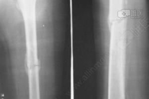 09-2-20治疗后55天.骨痂形成良好,局部无压痛和纵扣痛,去骨牵引.