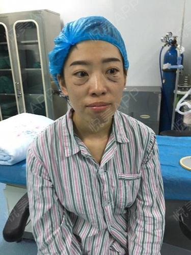 内切去眼袋术后1天_去眼袋术后1天_眼部术后1天_在乎分享图片6