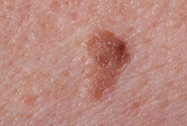 无论男女,手臂上长有这种小红点,或是感染hpv了,请别再抠