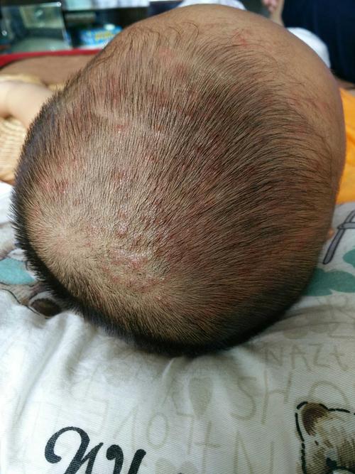 宝宝头上毛囊炎怎么处理