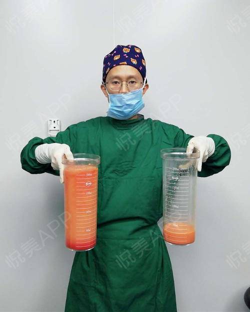 这是项院长抽出来的脂肪,是不是很多啊