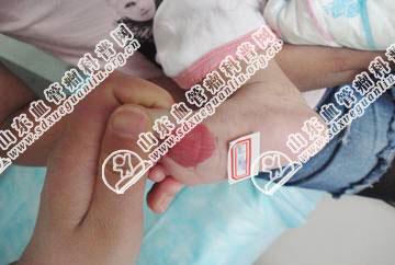 婴儿脚上血管瘤怎么办对孩子好