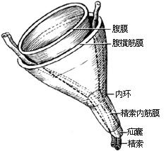 图1 腹股沟斜疝的解剖改变