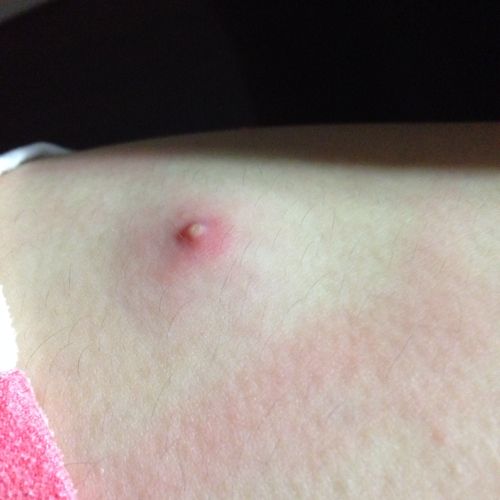 大腿上长了这样的痘痘 又疼又痒 为什么会这样 什么病