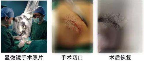 显微镜下精索静脉曲张结扎术 解"