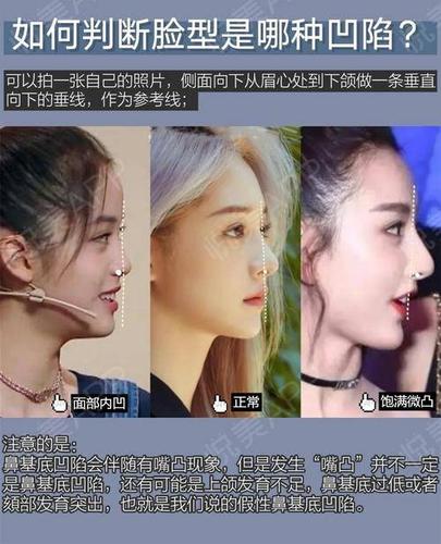 如何判断鼻基底是否凹陷