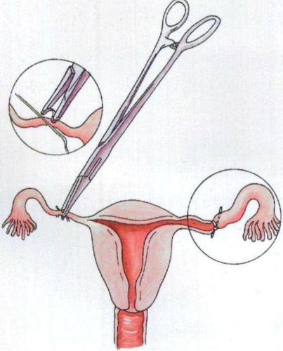 关于男性和女性结扎,谁的风险更小?男性结扎后身体无力是真的吗