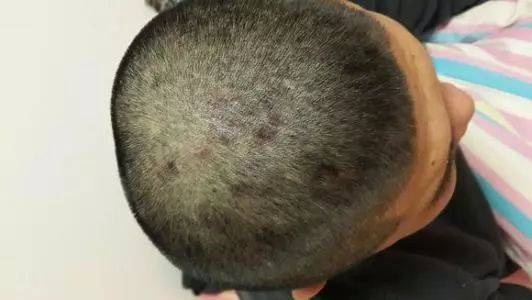 头部脂溢性皮炎,很难治疗吗?