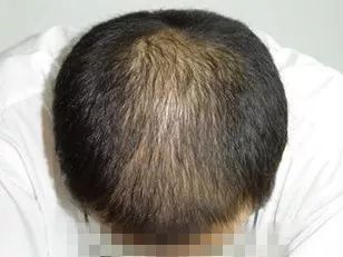 今天我们不谈梦想,不谈压力,只谈脱发