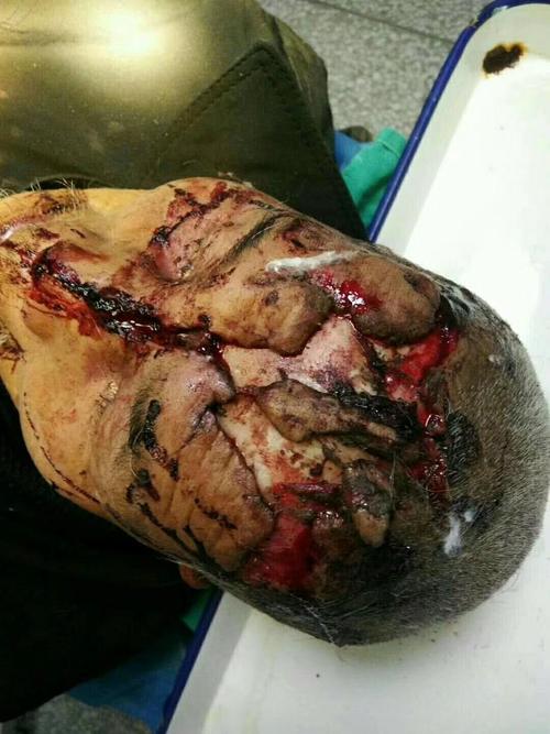 头皮撕裂伤并大面积缺损