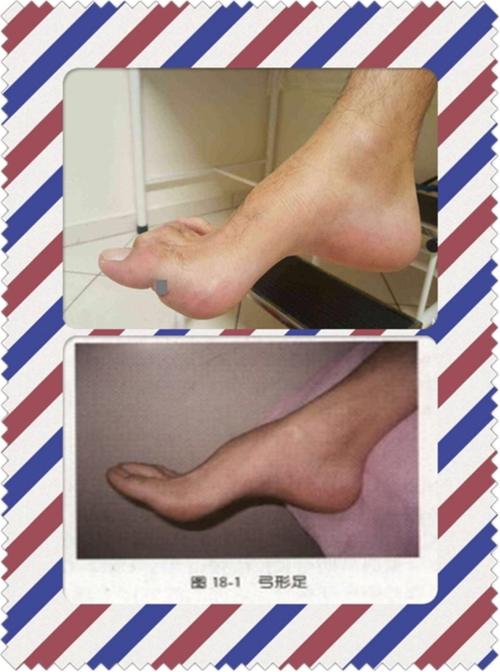 典型的弓形足