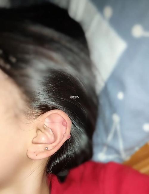 耳骨增生_耳骨_耳骨钉_耳钉_瘢痕疙瘩_医疗健康_医疗