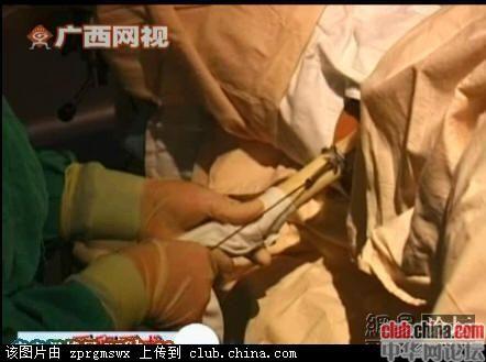 长知识了:图揭广西医院视频直播人工授精全程