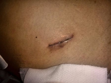 9月29日做了阑尾炎手术,一直未出院,现在外面的伤口还