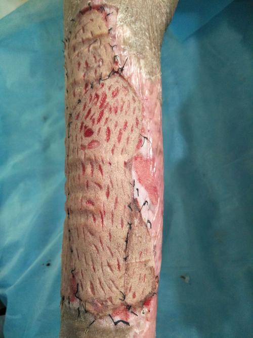 植皮术后一周换药见患者植皮区皮肤百分百成活!