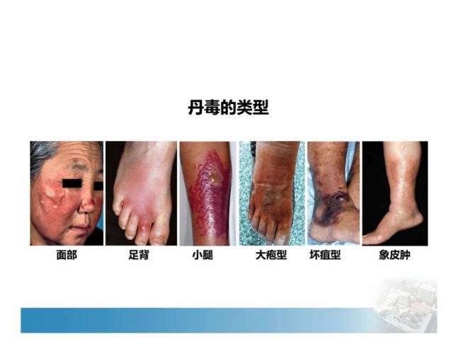 5丹毒和蜂窝织炎.pdf 11页