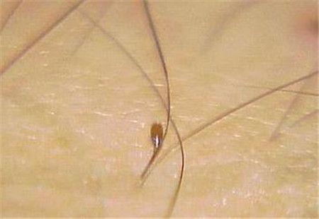 阴虱会自愈吗 阴虱真的会自己消失吗?