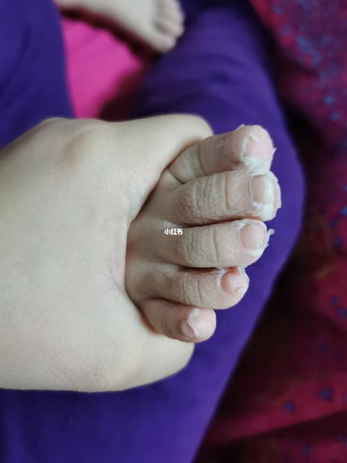 密集恐惧症慎入,手足口过后的手脚脱皮_宝宝手足口病