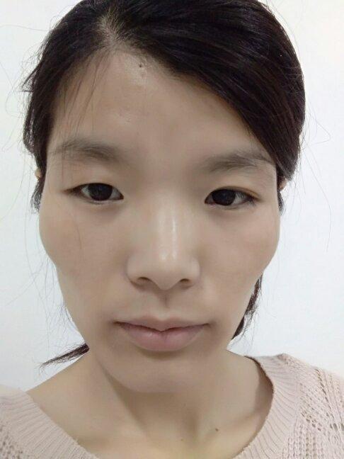 觉得自己的脸型不好看,颧骨那块好高,呜呜呜 22岁的时候矫正牙齿拔了