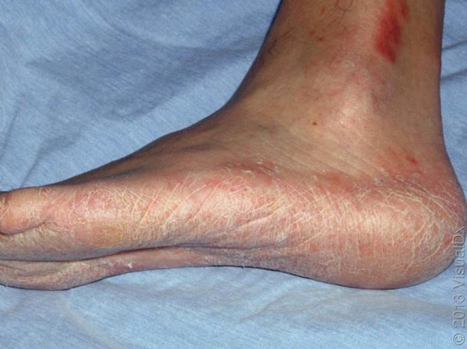 角化型足癣(引自参考文献)