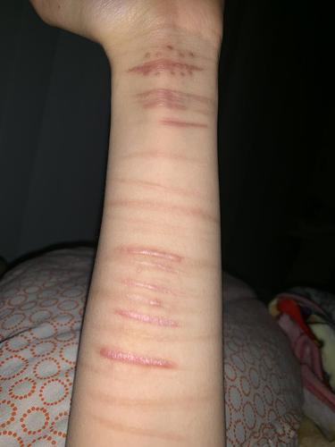 你们怎么接受自己的伤疤