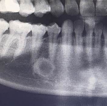 这是牙齿的x光片,那个牙齿根部的圆形是什么东西,要不要紧