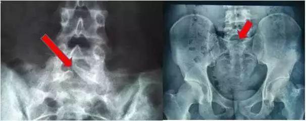 需要治疗吗?能治疗好吗?骶椎隐裂,如果没有症状无需治疗.