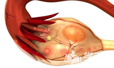 卵巢瘤是什么是否能够治愈