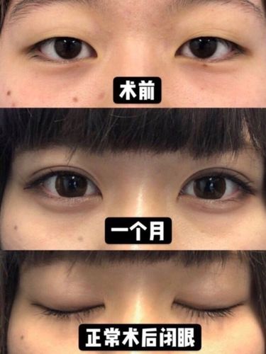我只想做双眼皮医生却让我做上睑提肌是不是忽悠我