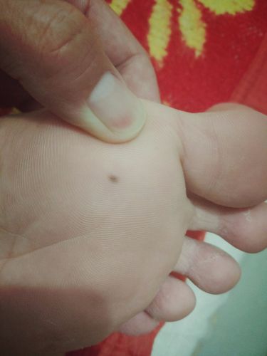谁知道脚掌上长的这个痣是不是黑色素瘤?边缘是模糊的