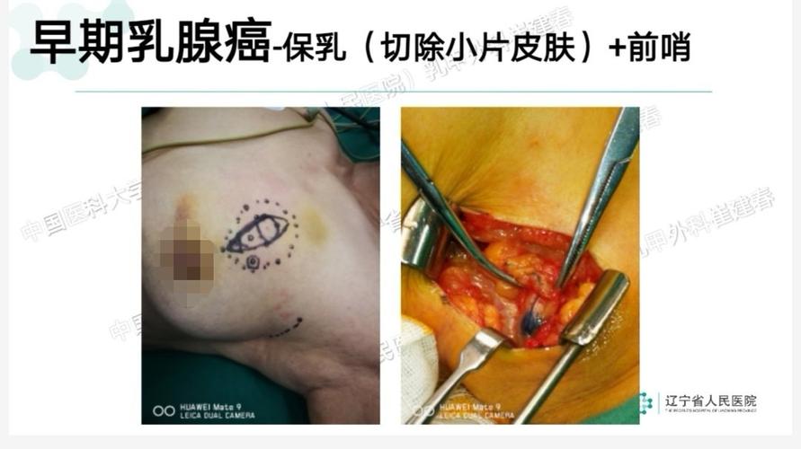 乳管镜和乳腺旋切挑战早期乳腺癌传统模式的保乳手术