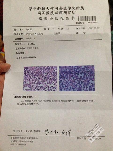 宝宝被查出恶性骨癌,求助各位啦!