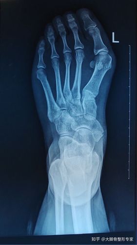 大脚骨和小脚骨x光片