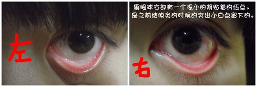 结膜炎.