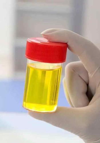 淡绿色尿液图片 如果你的尿是这个颜色,要警惕.