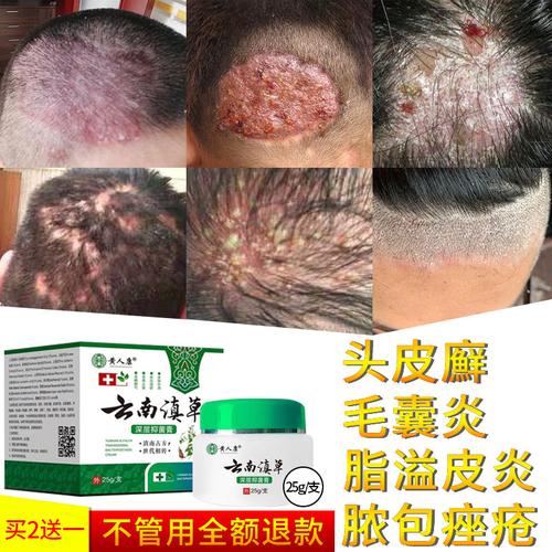 去毛囊炎脂溢性皮炎头皮头部脓包疮神器治疗银屑湿疹专用的癣药膏