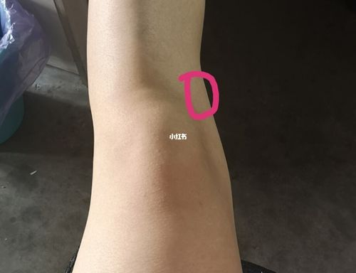 膝盖这块痛怎么办呀_跑步_医疗健康_医疗健康其他