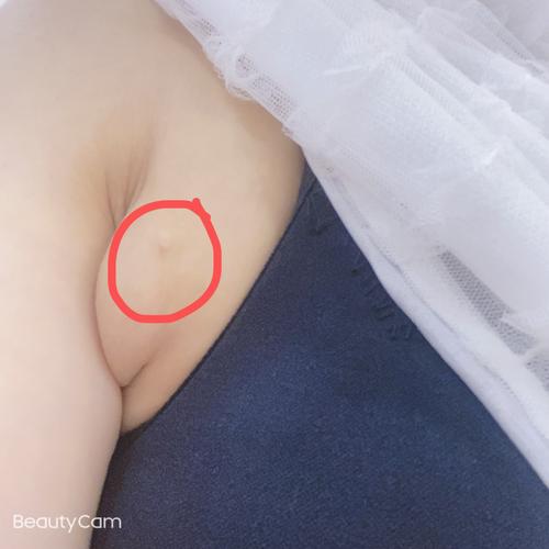 生完孩子2年半了,左腋下留下了一大坨副乳,并且还有小乳头,超级难看.