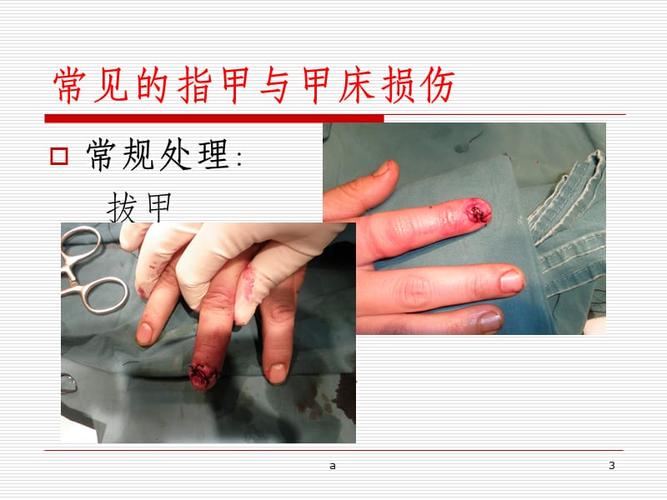 指甲与甲床损伤的处理探讨.ppt