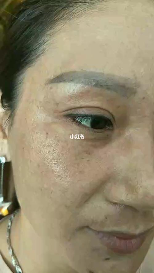 11566 颧骨,肝斑(肝气郁结斑)_子宫_黄褐斑_腰椎_痛经_染发_妇科