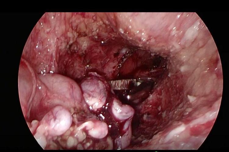 游离正常的肠管置于肛门处行无张力吻合