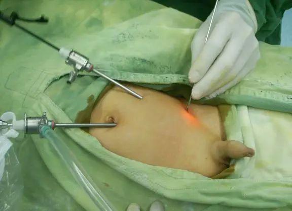 腹腔镜腹股沟斜疝/鞘膜积液修补术|手术_网易订阅