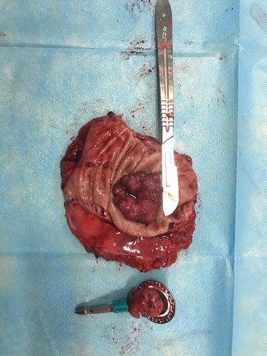 术后标本切开,见菜花样肿瘤.